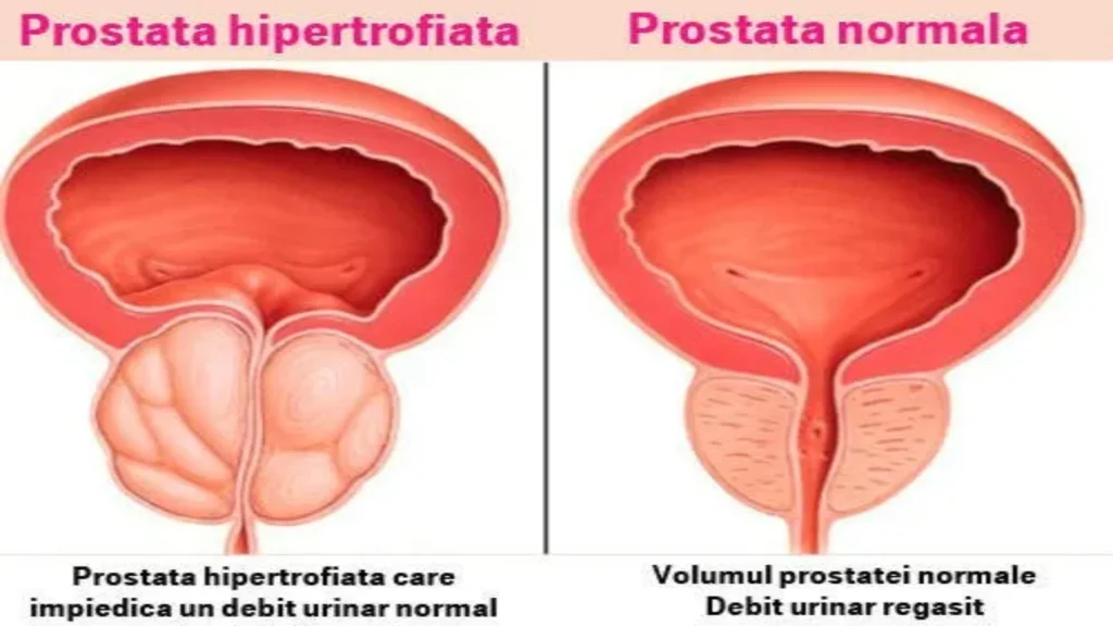 Prostaform beli dimana - diskon - di apotik - memesan - harga - Lazada - surabaya